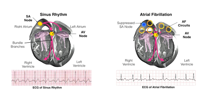 How Long Does Cardioversion Last The Centers For Disease Control And 